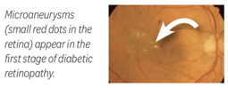 A diagram image showing microaneurysms in the human eye.